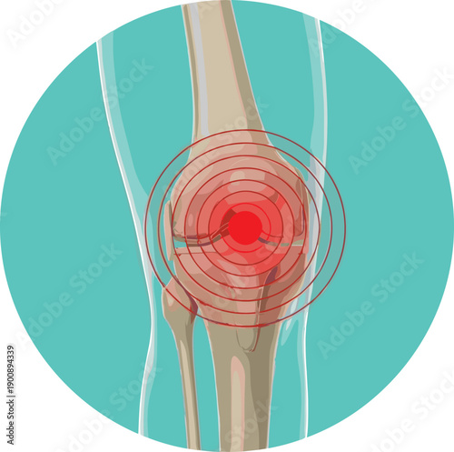 Medical illustration showing knee joint pain with red target highlight, representing arthritis inflammation, injury, orthopedic problem, joint disease, healthcare concept, 