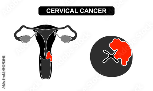 Cervical Cancer Illustration Concept, the growth of cancer cells in the cervix. vector flat illustration for medical, education, science, and the concept of disease in reproductive organs.