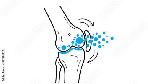 Knee Joint Injection Therapy Diagram. Orthopedic Medical Treatment Illustration showing Infusion of Stem Cells or Hyaluronic Acid into Synovial Fluid.