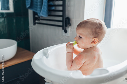 Photos Atopic dermatitis skin care routine