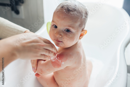 Atopic dermatitis skin care. Mother bathing her daughter with eczema all over body. Mom taking care of infant baby at home