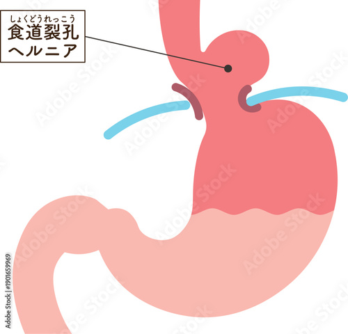 食道裂孔ヘルニアのイラスト　Hiatal hernia illustration
