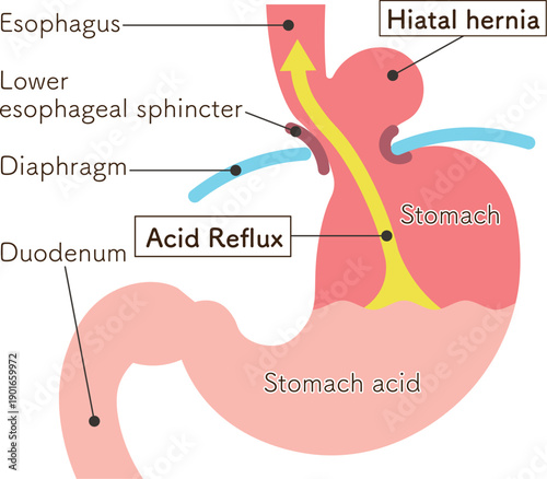 食道裂孔ヘルニアのイラスト　Hiatal hernia illustration