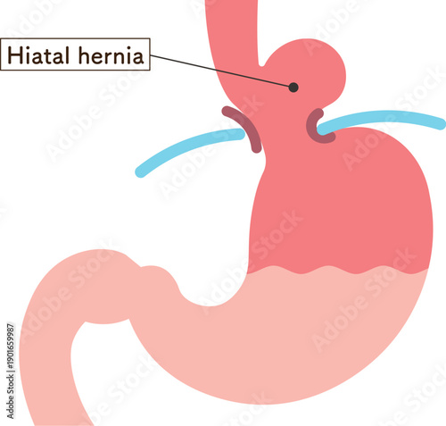 食道裂孔ヘルニアのイラスト　Hiatal hernia illustration