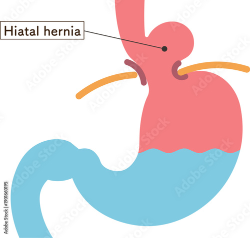 食道裂孔ヘルニアのイラスト　Hiatal hernia illustration
