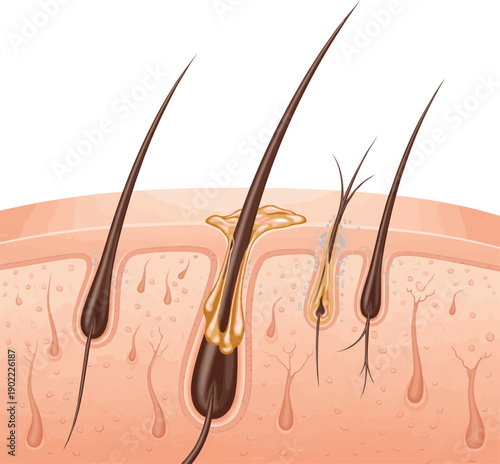 Isolated a realistic Oily Scalp and Clogged Follicles Causing Weak Hair. vector art with white background.