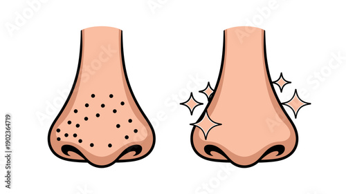 Cartoon noses with blackheads and clean skin comparison