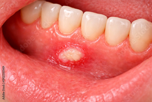 Oral Canker Sore on Inner Lip – Aphthous Ulcer