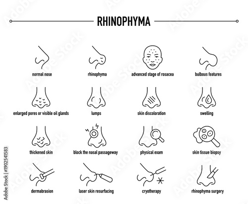 Rhinophyma symptoms, diagnostic and treatment vector icon set