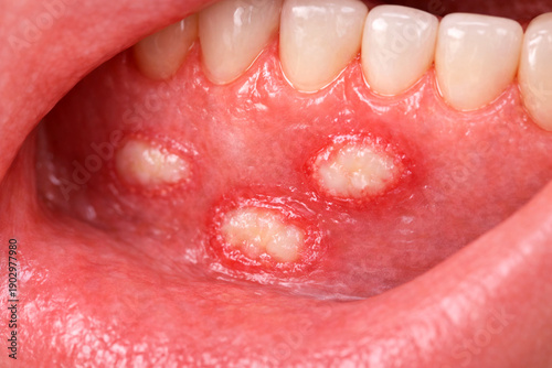 Multiple Oral Canker Sores  Aphthous Ulcers in Mouth