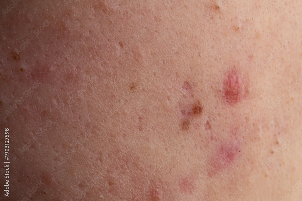 Fototapeta premium Acne on skin closeup. Acne macro pimple on skin. Acne texture in pores. Acne macro for dermatology.