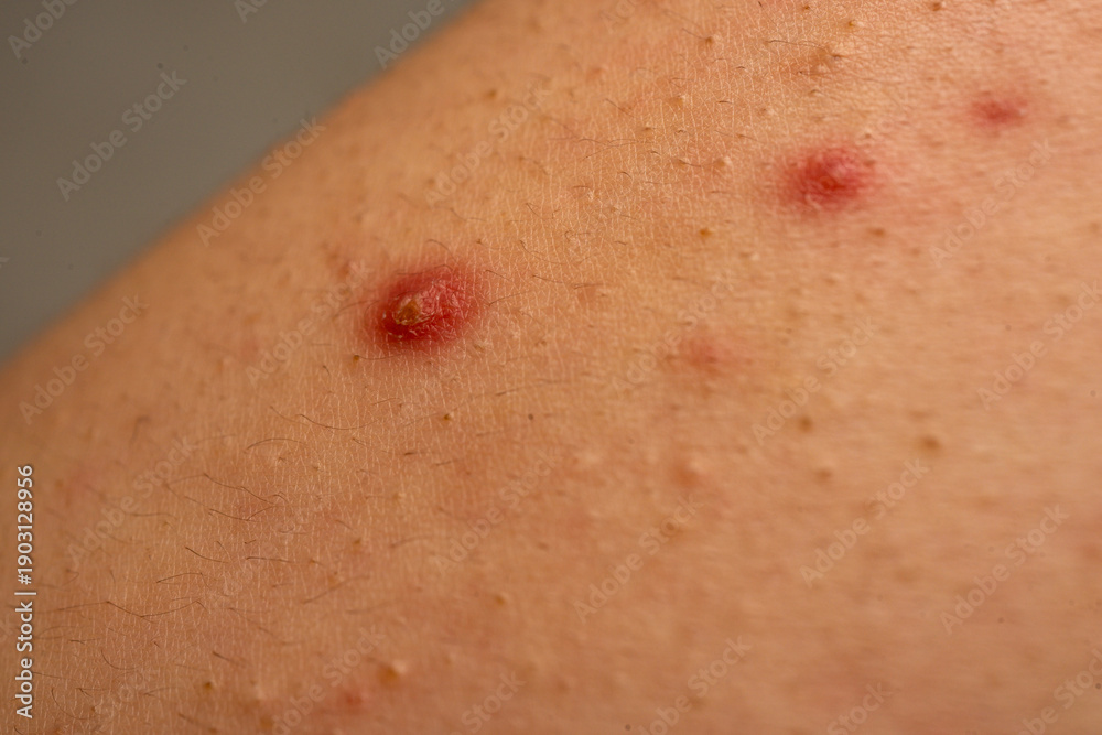 Fototapeta premium Close up pimple with acne skin problem and pores background. Acne close up with pimple, blackhead, and sebum detail. Pimple acne close up for dermatology. Close up acne skin issue with papules.