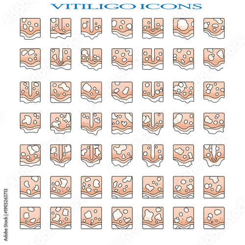 Vitiligo Skin Condition Concept Showing Loss of Pigmentation on Human Skin