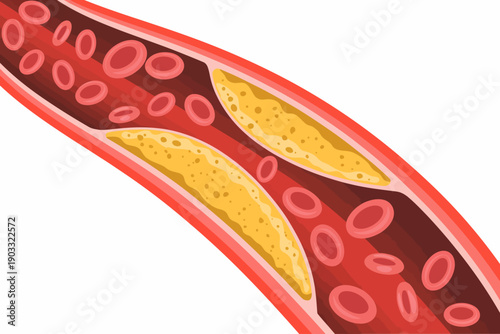 Cross section of artery showing plaque buildup and red cells circulation