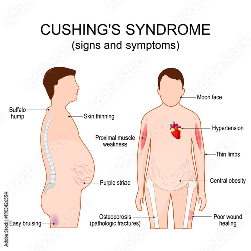 Cushing's syndrome. Signs and symptom of Cushing disease.