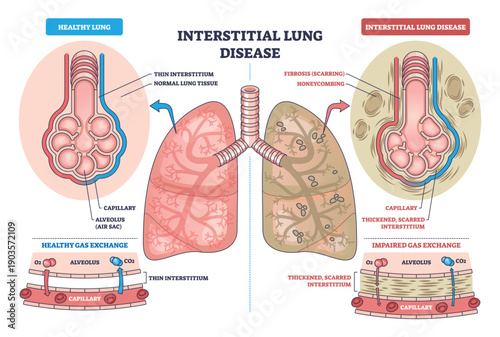 Interstitial lung disease outline contrasts healthy vs fibrotic lungs, showing alveoli thickening and impaired gas exchange, key objects, lungs, alveoli, capillaries. Outline diagram