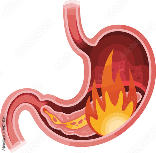 Human stomach showing inflammation and heartburn with internal fire vector on white background.