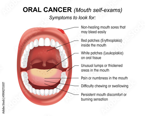 Oral Cancer (Mouth Only) – Warning Signs