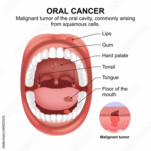 Oral Cancer Medical Flashcard Illustration