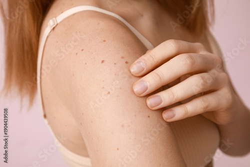 Cuadro en lienzo Young woman with moles on pink background, closeup