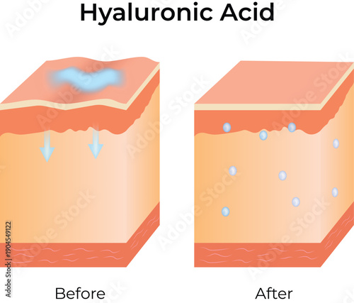 Hyaluronic Acid Skin Hydration and Plumping Effect Illustration