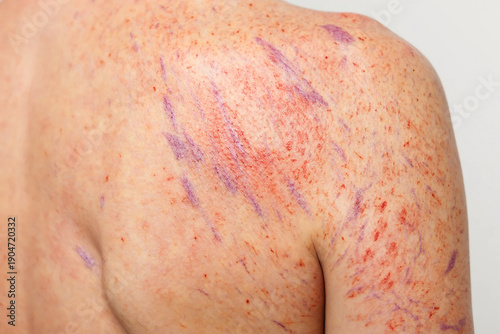 Mast Cell Activation Syndrome Close up of human skin with red marks and purple lines