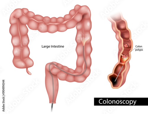 Detailed medical illustration  the colonoscopy procedure within the human large intestine. Anatomy of the colon and rectum, insertion of the endoscope, and visualization of colon polyps 