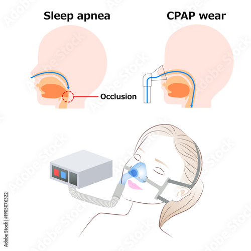 Continuous positive airway pressure (COAP) during sleep
