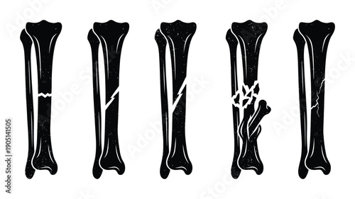 Bone fracture types vector illustration depicting various stages of fractures and their damage levels