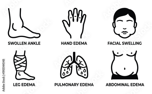 Edema types vector illustration: swollen ankle, hand, facial, leg, pulmonary, abdominal edema symptoms