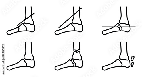 Foot fracture types illustration with break lines, side view, ankle and bones in outline style on white background