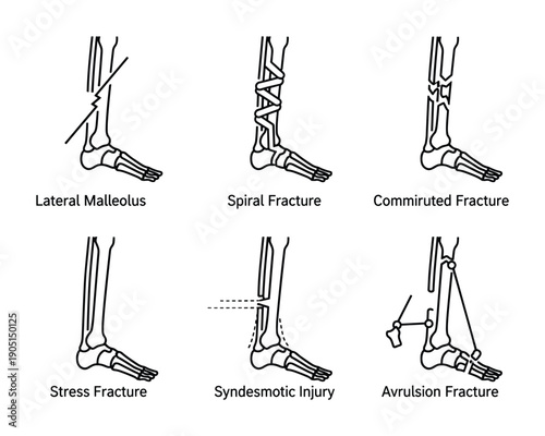 Leg bone fractures illustration: lateral malleolus, spiral, comminuted, stress, syndesmotic injury, avulsion fractures.
