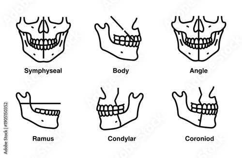Mandibular Osteotomy Sites Diagram Vector Illustration Anatomy Jaw Surgery, Body, Symphyseal, Angle, Coronoid, Condylar, Ramus