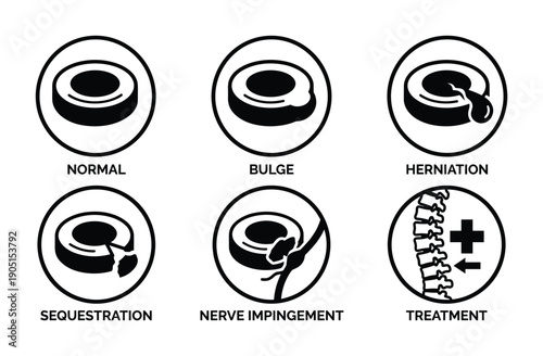 Spinal disc condition diagrams normal bulge herniation sequestration nerve impingement treatment medical illustrations
