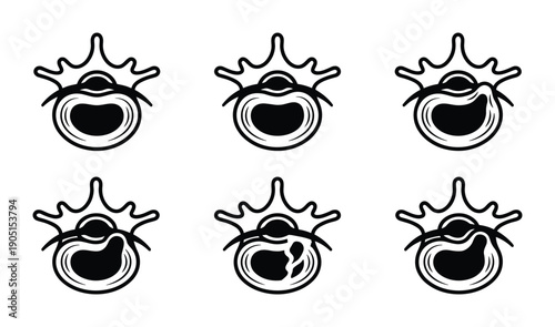 Spinal disc herniation stages. Illustrating healthy disc, bulging disc, protruded disc and extruded disc.