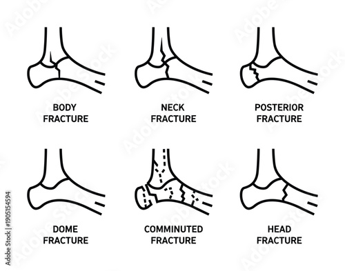 Types of bone fractures: Body, neck, posterior, dome, comminuted, and head fracture diagram illustrations.