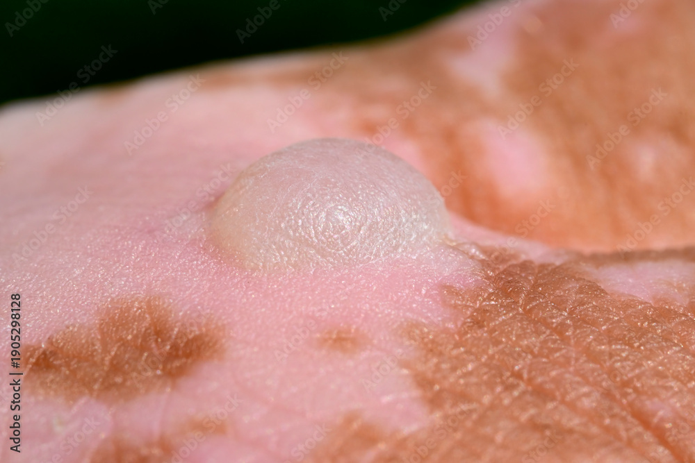 Fototapeta premium Burn blister – burns caused by skin contact with giant hogweed (Heracleum mantegazzianum)