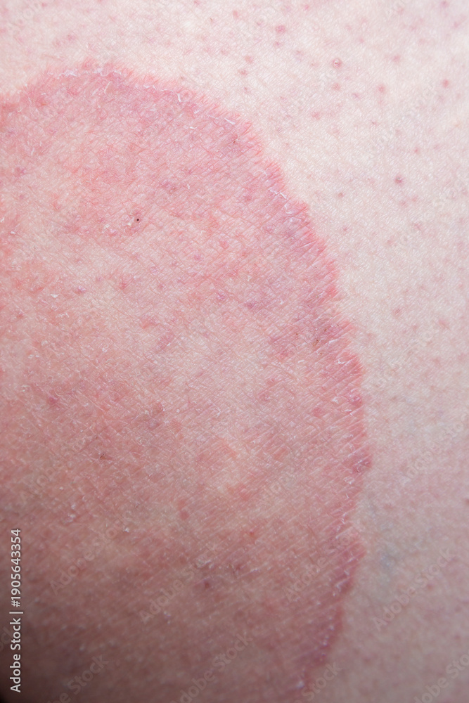 Fototapeta premium Jock itch (Tinea cruris) on the skin of a man