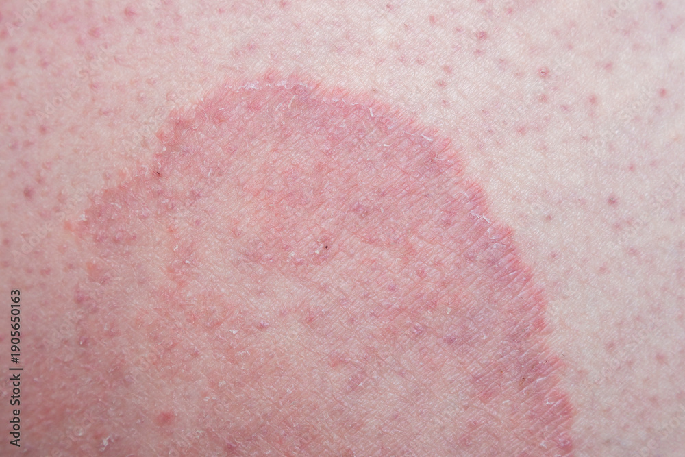 Fototapeta premium Jock itch (Tinea cruris) on the skin of a man