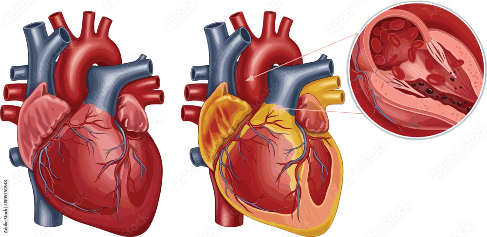 © Bappi - Detailed vector illustration set of the human heart featuring a healthy anatomy, arterial blockage, and vascular cross-section