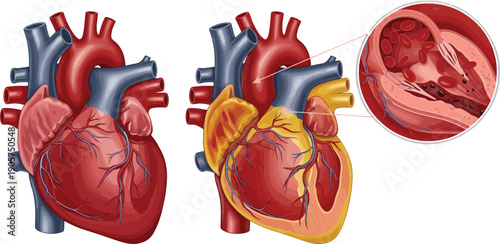 Detailed vector illustration set of the human heart featuring a healthy anatomy, arterial blockage, and vascular cross-section