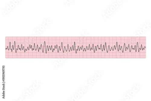Ventricular fibrillation showing chaotic electrical activity in the heart, an emergency cardiac rhythm