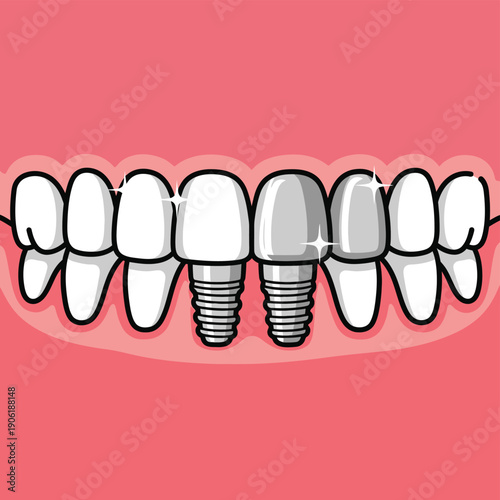 Dental implants illustration with healthy gums and white teeth