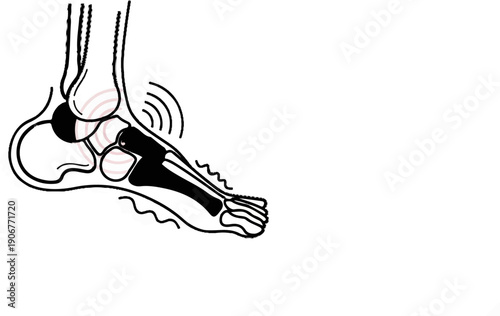 Anatomical illustration of an injured foot with pain indicators