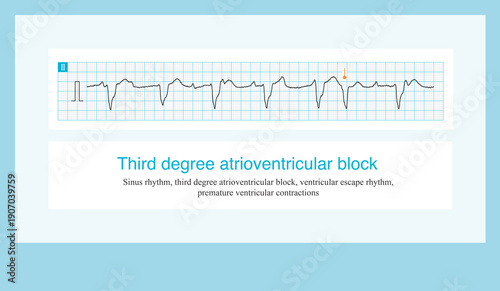 One case of third-degree atrioventricular block, with a ventricular escape rhythm and a wide QRS complex rhythm, during which a premature ventricular contraction occurred.
