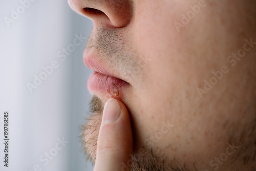 Foto Man suffering from a visible oral herpes cold sore outbreak on his lip, indicati