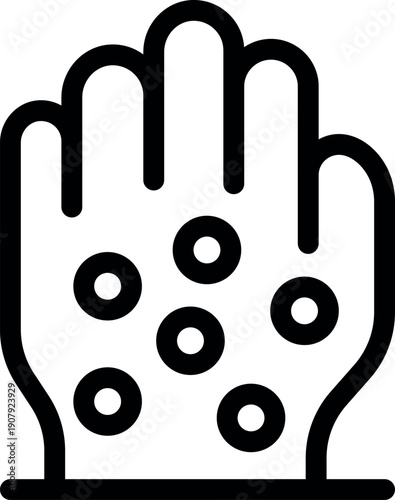 Open hand showing the characteristic rash or blisters of monkeypox or smallpox