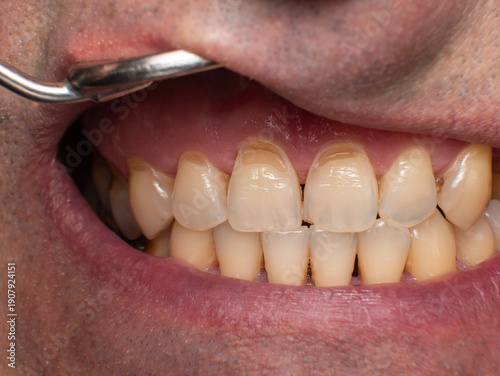 Obraz na plátně Maxillary front teeth with wedge-shaped cervical defects on all incisors, one fr