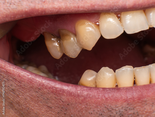Tableau sur toile Previously filled maxillary 4th and 5th teeth with plaque, caries and non‑cariou