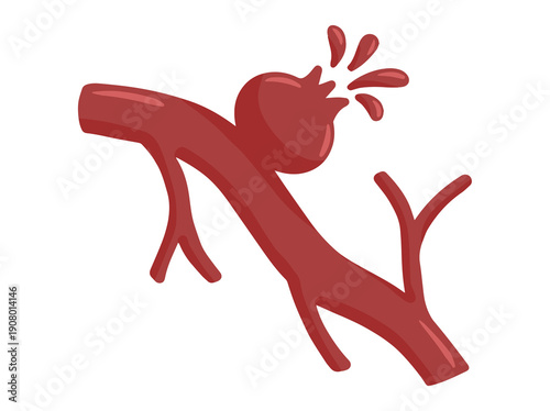 Ruptured Aneurysm Blood Vessel Clip Art
